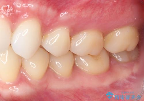 左下の奥歯が冷たいものがしみてザラザラする ゴールドインレー修復 の治療前