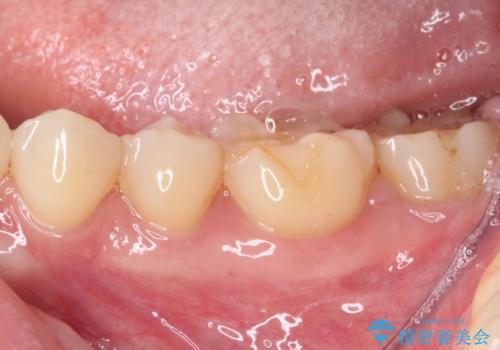 左下の奥歯が冷たいものがしみてザラザラする ゴールドインレー修復 の治療前