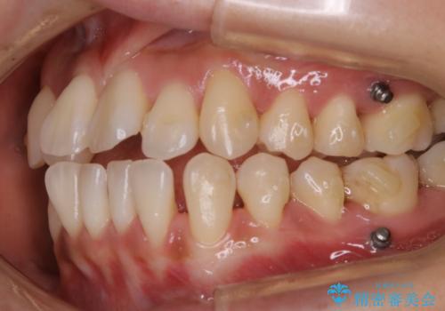 【非抜歯】左右の八重歯・前歯の反対咬合の改善 インビザラインの治療中