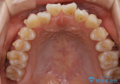 【非抜歯】左右の八重歯・前歯の反対咬合の改善 インビザラインの治療中
