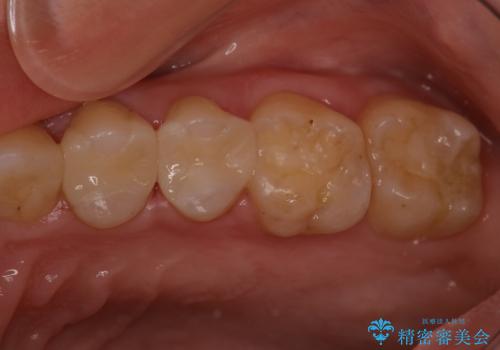 奥歯の着色が気になる セラミック治療