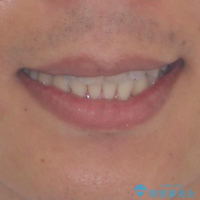 ワイヤー装置をインビザラインへ 装置変更での矯正治療の治療後(顔貌)