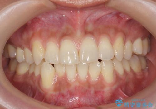 初めてのオフィスホワイトニングの治療前