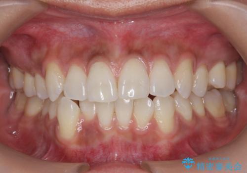 初めてのオフィスホワイトニング