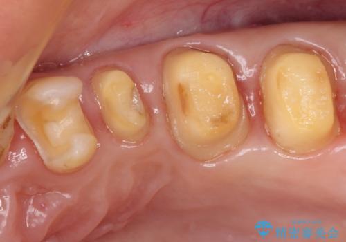 銀歯を白くしたい　セラミックによる審美歯科治療の治療中