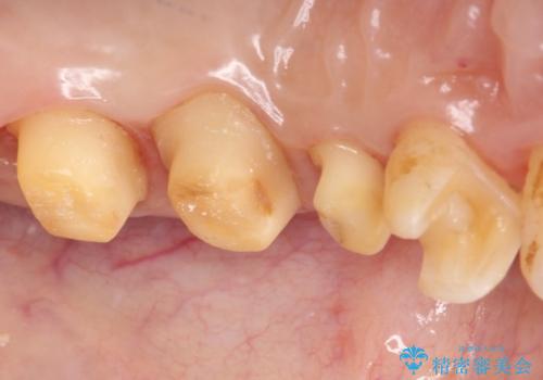 銀歯を白くしたい　セラミックによる審美歯科治療の治療中