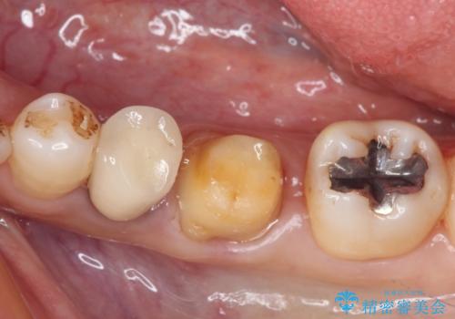 銀歯を白くしたい セラミックによる審美歯科治療の治療中