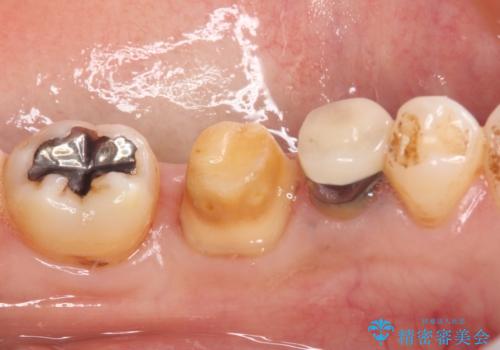 銀歯を白くしたい セラミックによる審美歯科治療の治療中