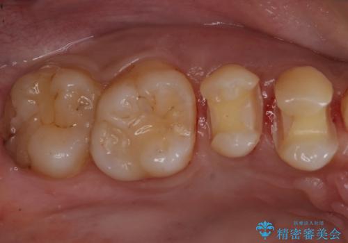 セラミック治療の治療中