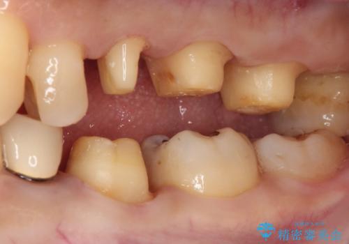 銀歯を白くしたい セラミックによる審美歯科治療の治療中