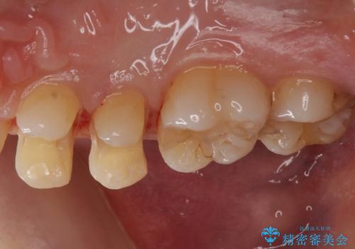 セラミック治療の治療中