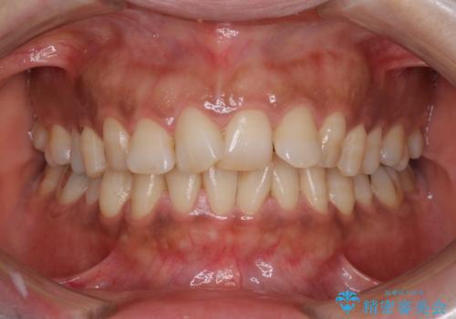 インビザラインでのんびりと矯正治療 の症例 治療前