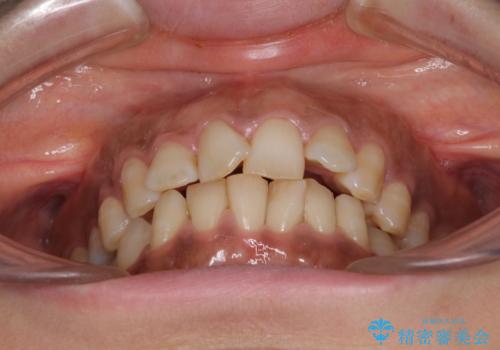インビザラインでのんびりと矯正治療 の治療前