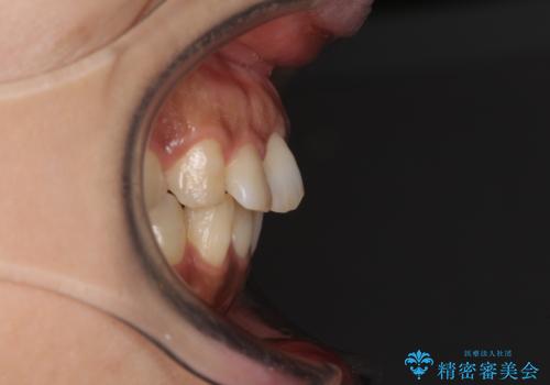 インビザラインでのんびりと矯正治療 の治療前