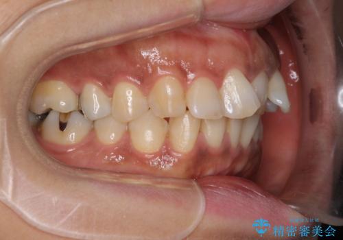 インビザラインでのんびりと矯正治療 の治療前