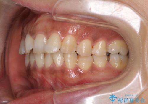 インビザラインでのんびりと矯正治療 の治療前