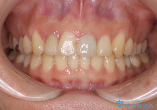 どこで咬めばいいかわからない 矯正治療で安定した咬み合わせにの治療後