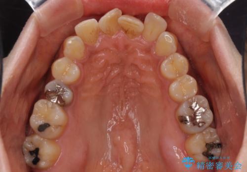 インビザラインでのんびりと矯正治療 の治療前