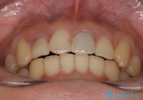 どこで咬めばいいかわからない 矯正治療で安定した咬み合わせにの治療後