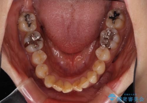 インビザラインでのんびりと矯正治療 の治療前