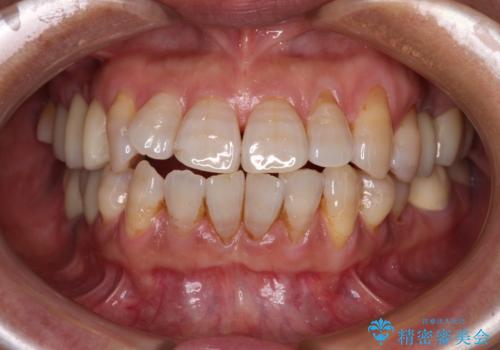 治療後に歯茎から出血 インプラントとオールセラミッククラウンの補綴治療の治療後