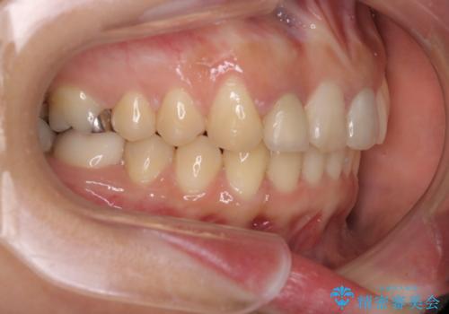 どこで咬めばいいかわからない 矯正治療で安定した咬み合わせにの治療後