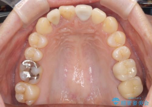 どこで咬めばいいかわからない 矯正治療で安定した咬み合わせにの治療後