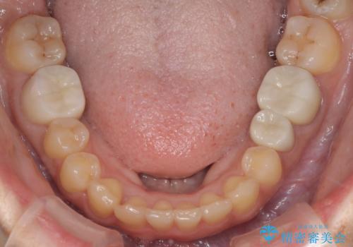 どこで咬めばいいかわからない 矯正治療で安定した咬み合わせにの治療後