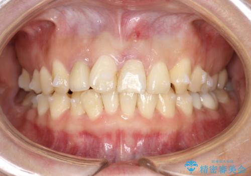どこで咬めばいいかわからない 矯正治療で安定した咬み合わせにの治療中