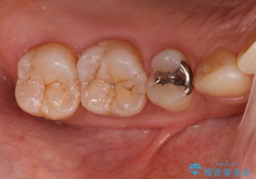 矯正終了し、銀歯が見えるため治してほしい。セラミック治療の症例 治療前