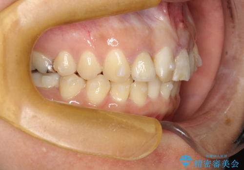 どこで咬めばいいかわからない 矯正治療で安定した咬み合わせにの治療中