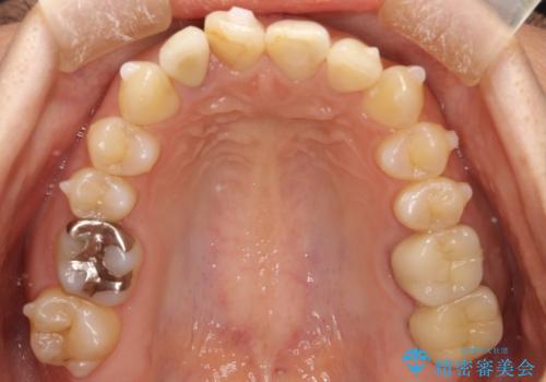 どこで咬めばいいかわからない 矯正治療で安定した咬み合わせにの治療中