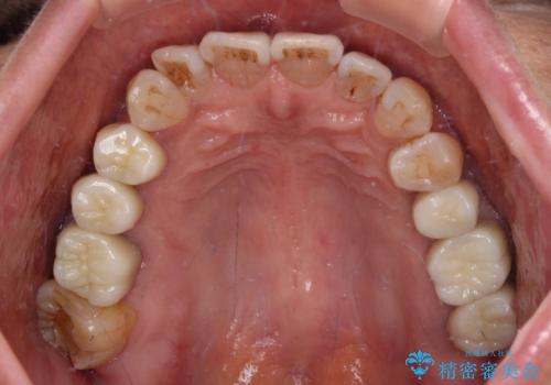 治療後に歯茎から出血 インプラントとオールセラミッククラウンの補綴治療の治療後