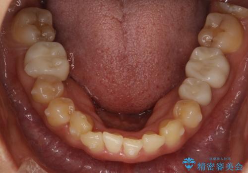 どこで咬めばいいかわからない 矯正治療で安定した咬み合わせにの治療中