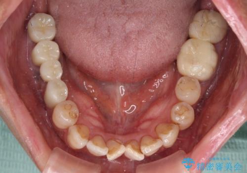 治療後に歯茎から出血 インプラントとオールセラミッククラウンの補綴治療の治療後