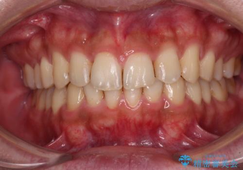 前歯のデコボコをスッキリ改善　インビザライン矯正の治療後