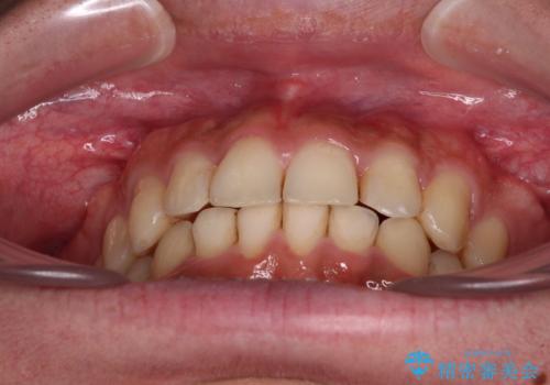 前歯のデコボコをスッキリ改善 インビザライン矯正の治療後