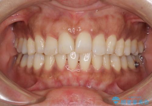 インビザラインでのんびりと矯正治療 の治療中