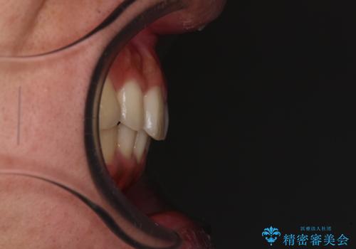 前歯のデコボコをスッキリ改善 インビザライン矯正の治療後