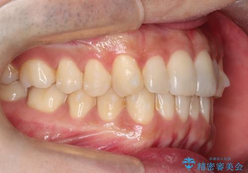前歯のデコボコした歯並びをマウスピースで改善!の治療中