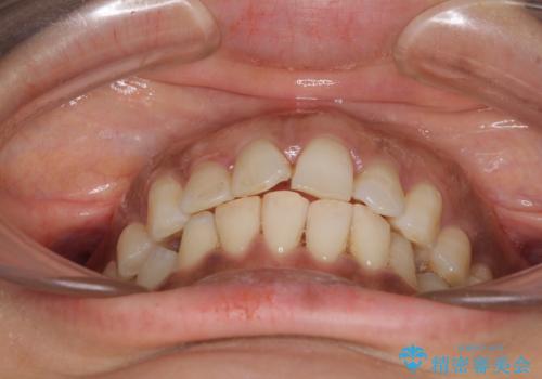 インビザラインでのんびりと矯正治療 の治療中