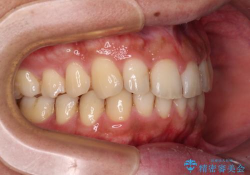 前歯のデコボコをスッキリ改善 インビザライン矯正の治療後