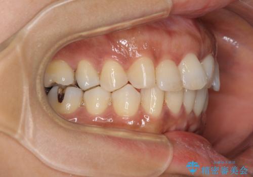 インビザラインでのんびりと矯正治療 の治療中