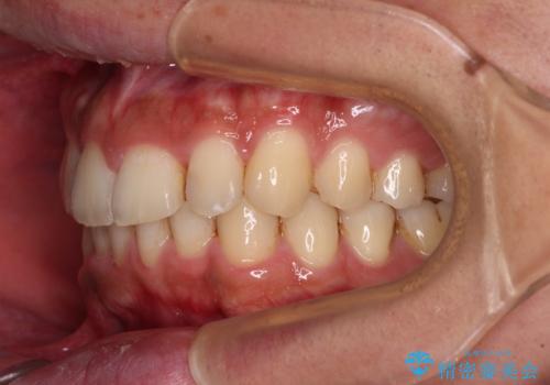 前歯のデコボコをスッキリ改善 インビザライン矯正の治療後