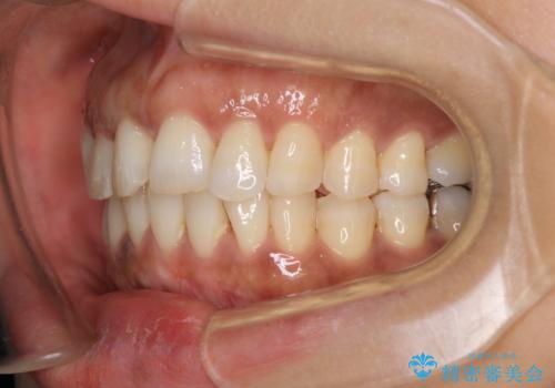 インビザラインでのんびりと矯正治療 の治療中