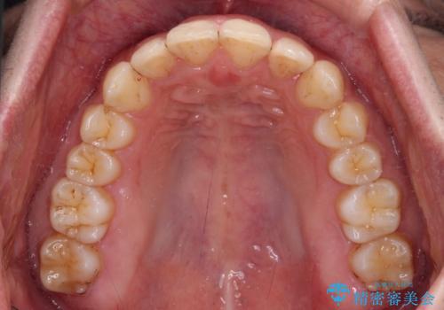 前歯のデコボコをスッキリ改善　インビザライン矯正の治療後