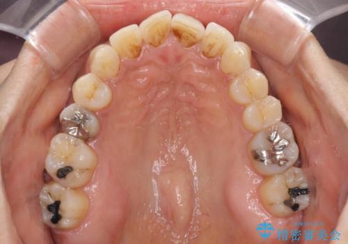 インビザラインでのんびりと矯正治療 の治療中