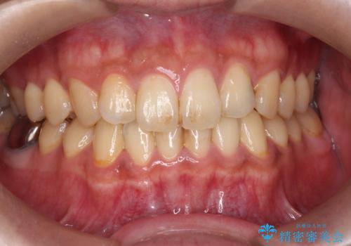 歯の着色を除去し、きれいな歯に!の症例 治療前