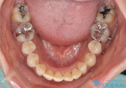 インビザラインでのんびりと矯正治療 の治療中