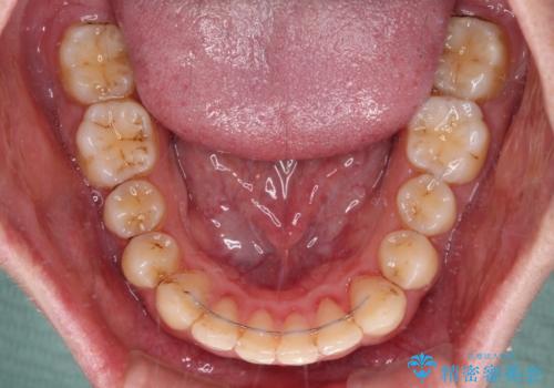 前歯のデコボコをスッキリ改善 インビザライン矯正の治療後